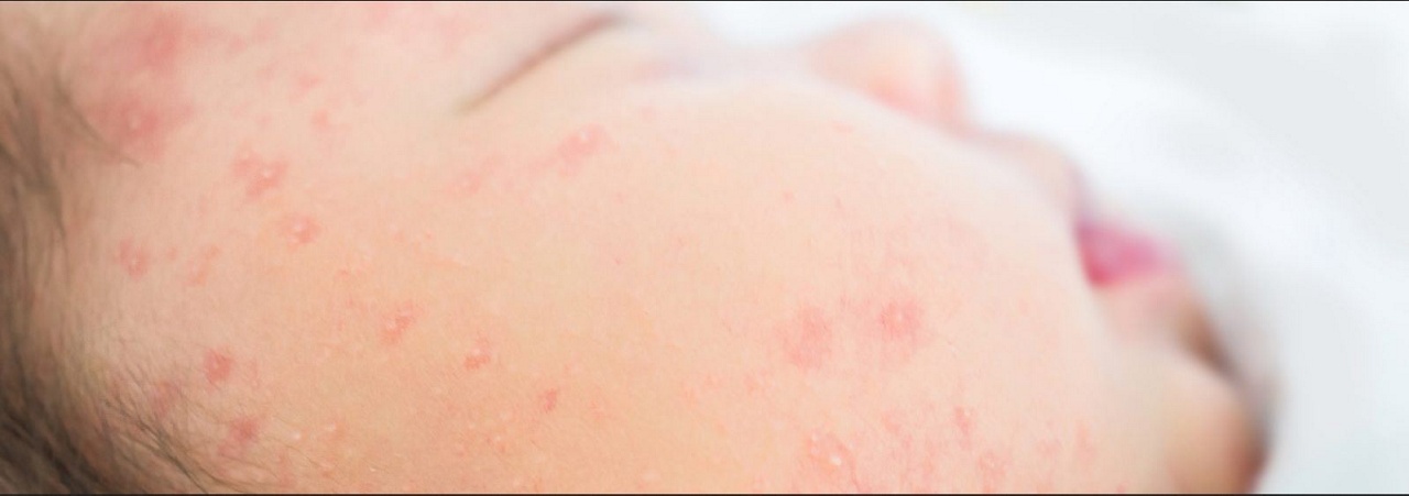 Αλλεργίες: από την αποφυγή στην έκθεση μέσω της διατροφής