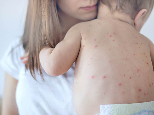 Mother holding a baby with allergy on his back