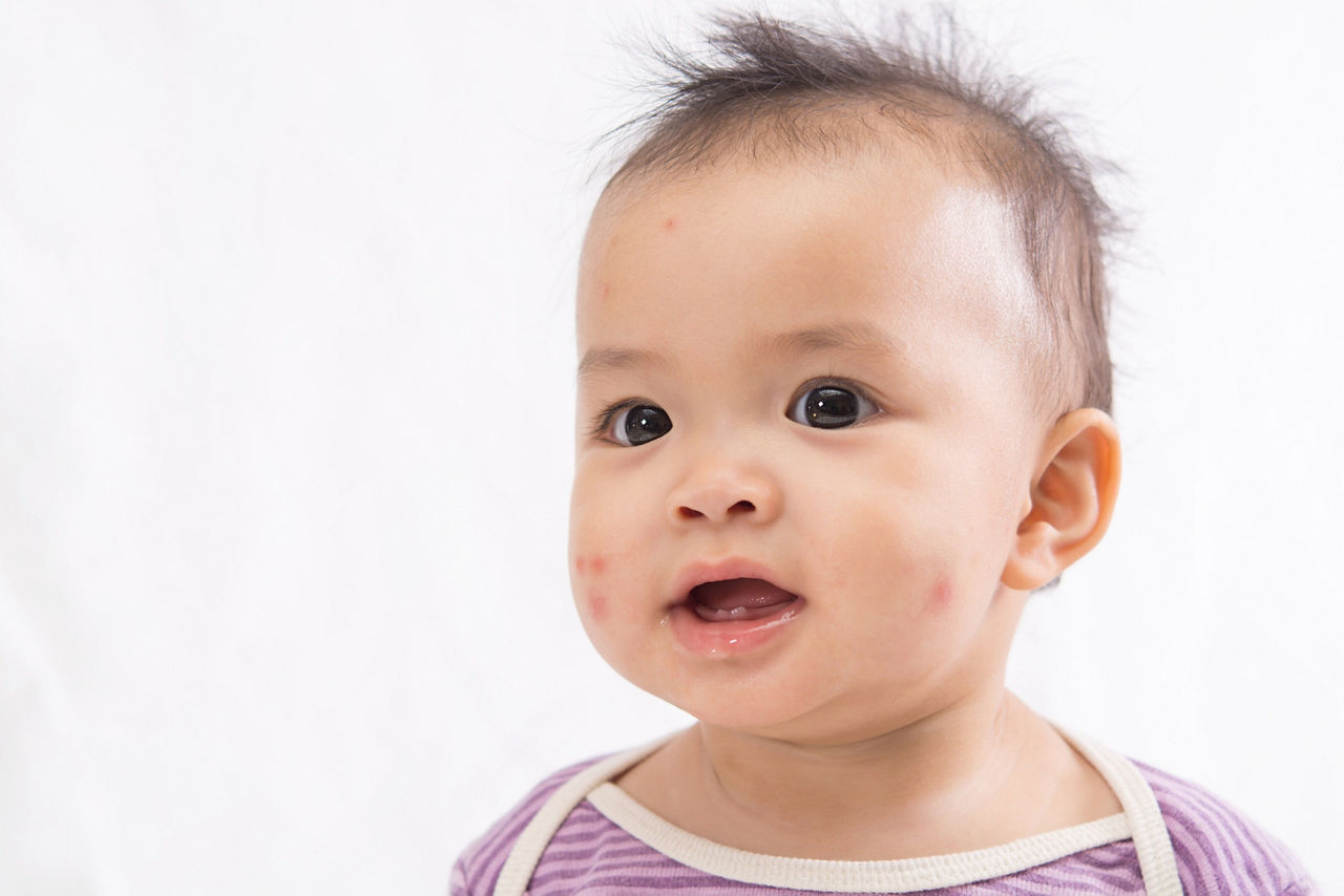 Asian baby with a big red spot from mosquito bite on a face