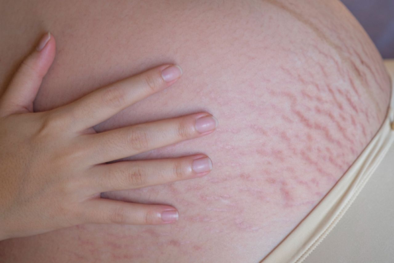 Hochschwangere Frau mit Dehnungsstreifen am Bauch