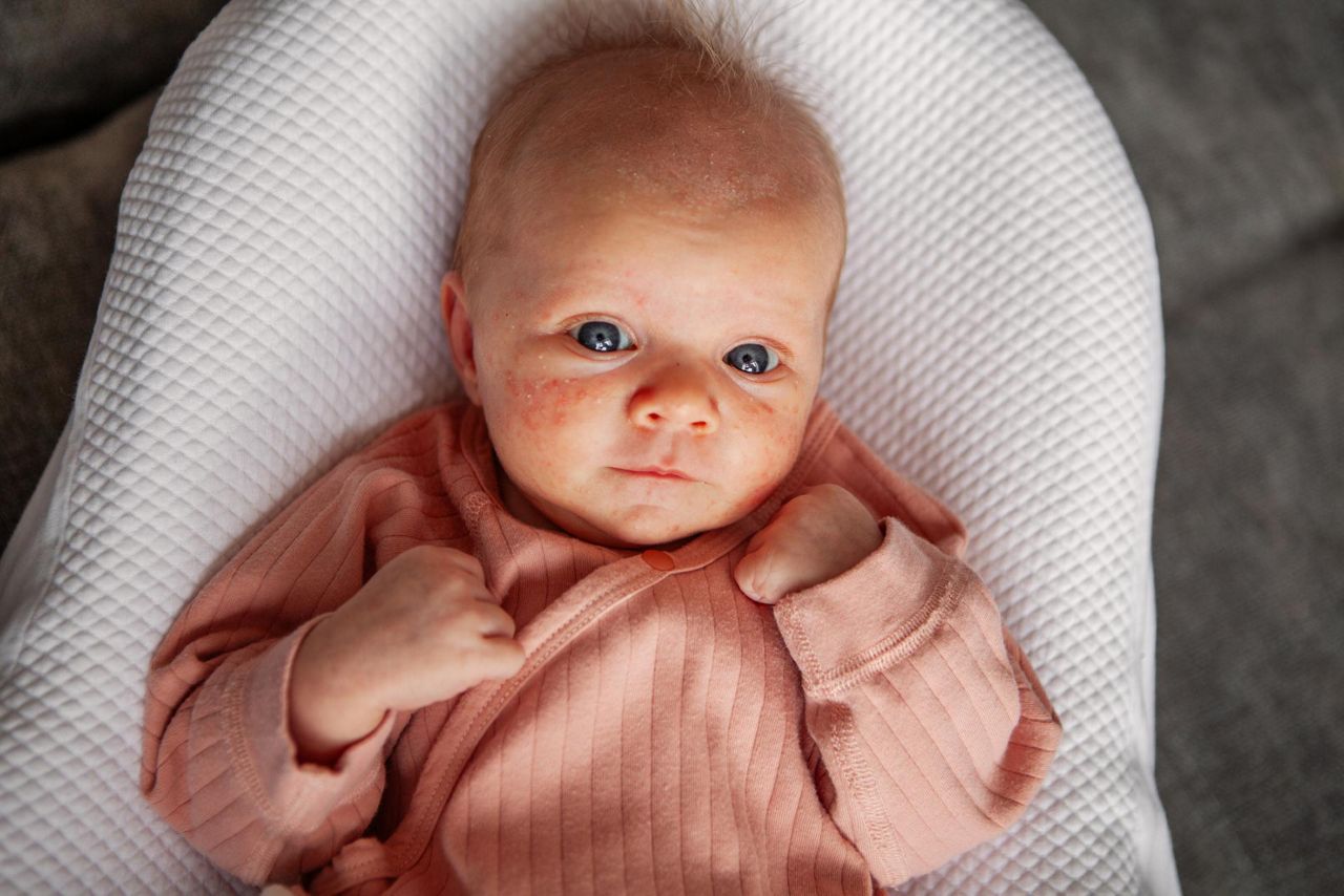 Baby mit Babyakne