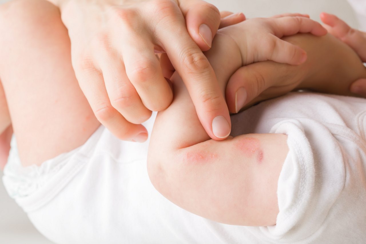 Hand eines Kindes mit Hautproblemen