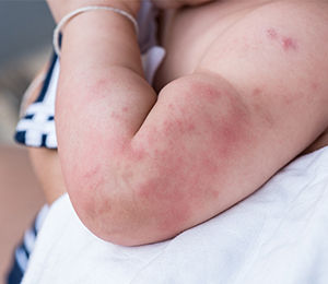 Mother holding a baby with allergy on his back