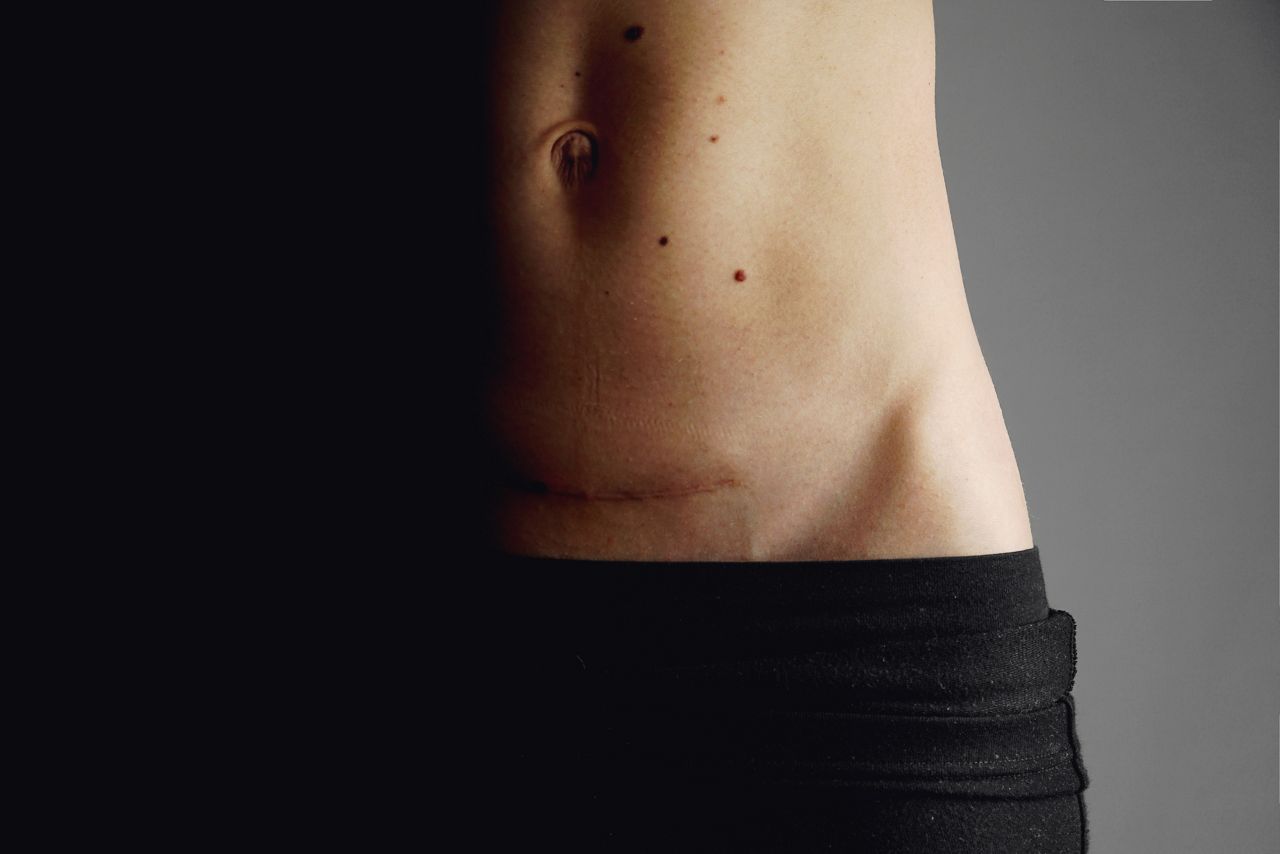 Closeup of woman belly with a scar from a cesarean section and heart health