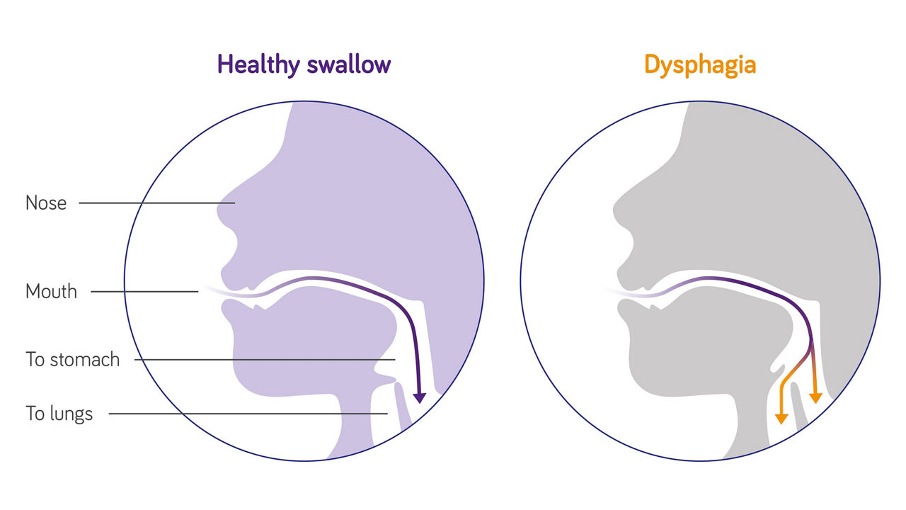 What is a clinical 2025 condition that could affect deglutition