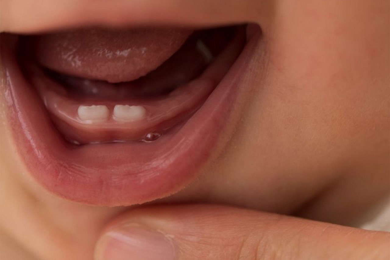 Οδοντοφυΐα στα βρέφη: Όλα όσα πρέπει να γνωρίζετε!