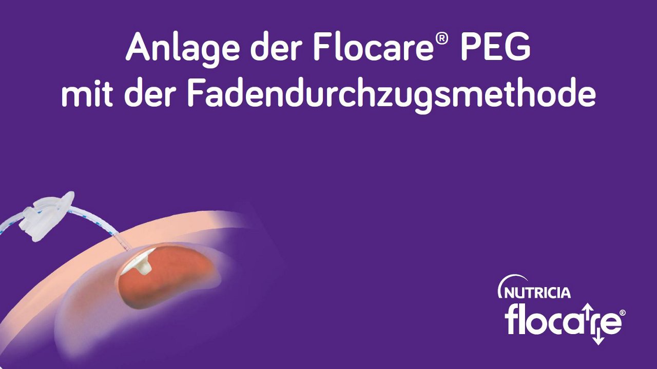 Anlage der Flocare PEG mit der Fadendurchzugsmethode thumbnail