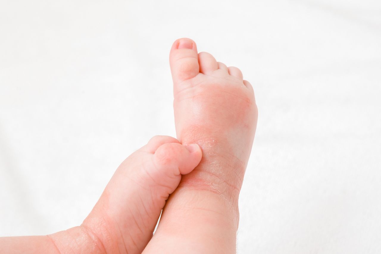 Infant legs with red dry skin. Suffering from allergy of milk formula or other food. Closeup.; Shutterstock ID 1588440745; purchase_order: DNC thumbnails ; job: Allergy papers; client: ; other: 