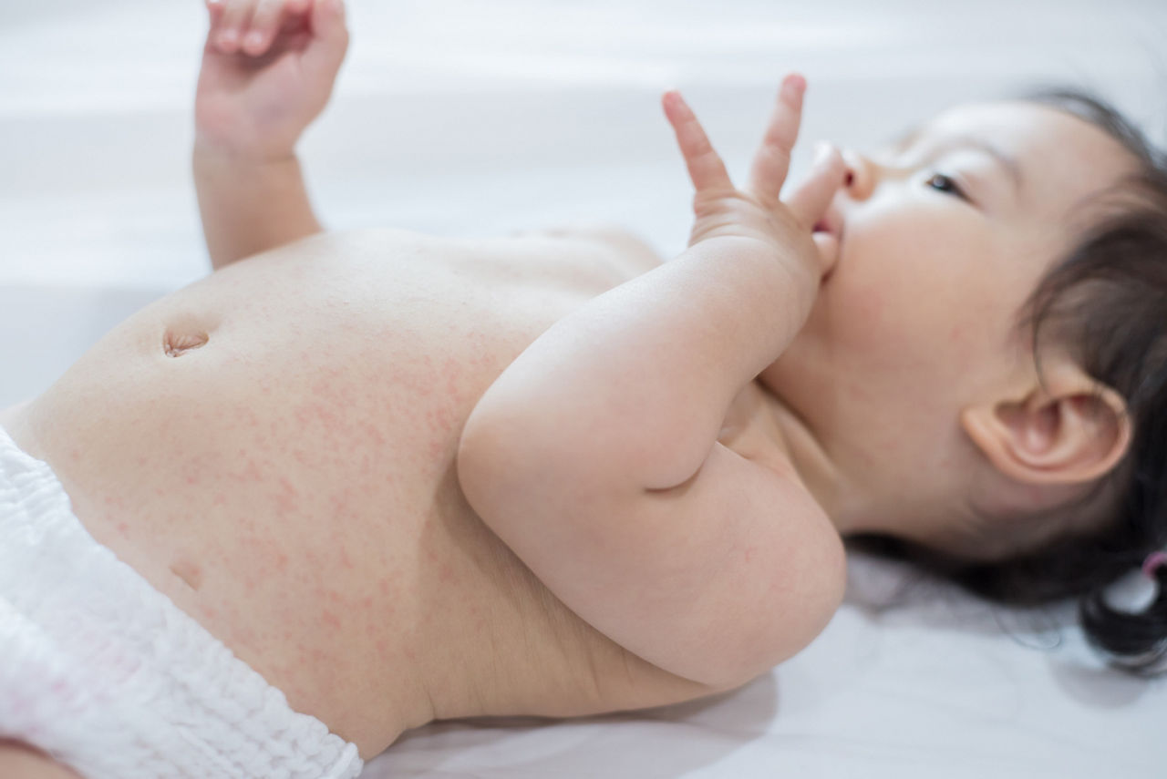 baby rash skin, prickly heat on baby (selective focus)	; Shutterstock ID 2031026471; purchase_order: -; job: -; client: -; other: -