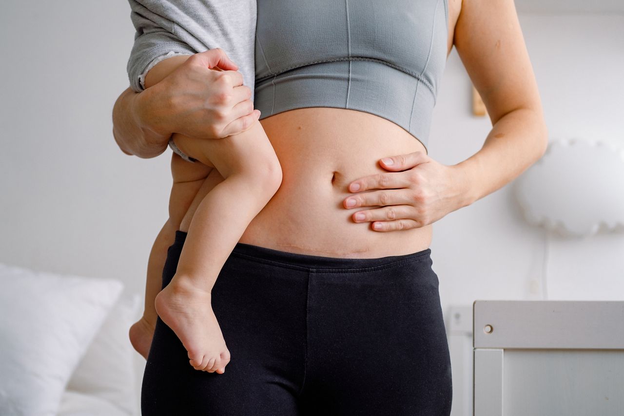 Close up of a belly with scar from c-section. A woman holding a baby showing her imperfect body. An abdomen with scar from Caesarian section.; Shutterstock ID 2139154233; purchase_order: DNC Thumbnails; job: Infographics; client: ; other: 