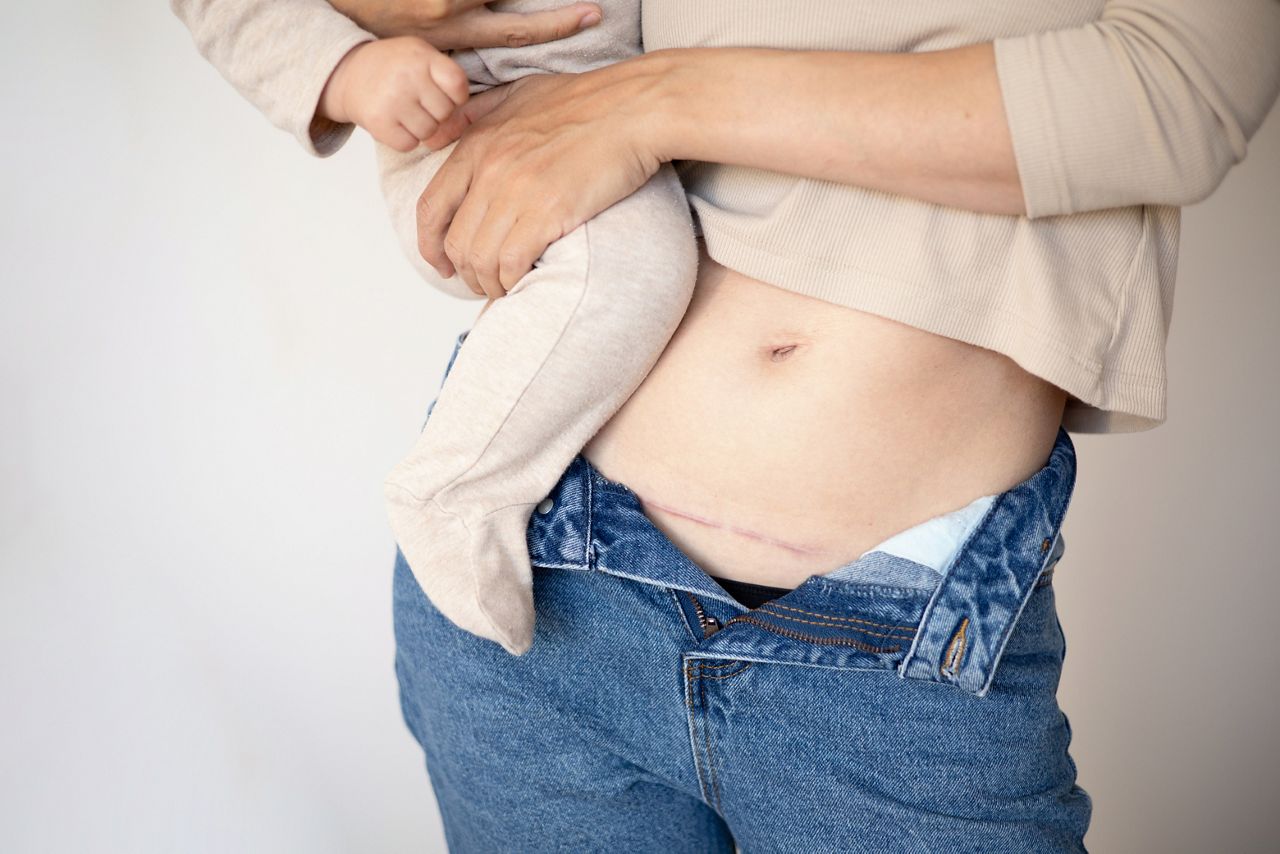 Mom's abdomen after cesarean section. Scar seam. A young mother holds the baby in her arms. Real motherhood. Lifestyle. High quality photo; Shutterstock ID 2183752405; purchase_order: DNC Thumbnails; job: Webinars 2 (50/188); client: ; other: 