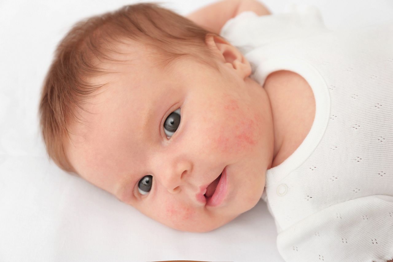 Adorable baby with skin allergy on light background; Shutterstock ID 732808234; purchase_order: DNC Thumbnails; job: Webinars 2 (50/188); client: ; other: 