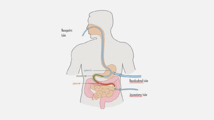 tube-feeding-diagram