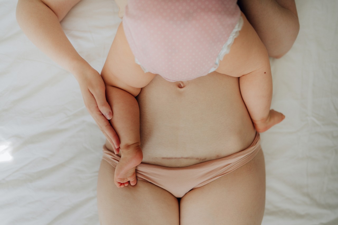 Photo of mother with c-section scar on a belly and her baby lying on the bed